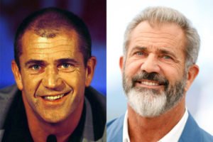 El antes y el después del implante capilar de Mel Gibson