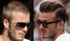 El antes y el después del implante capilar de David Beckham