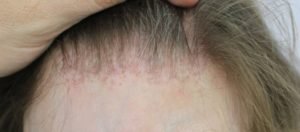 Paciente femenino con Alopecia Frontal Fibrosante