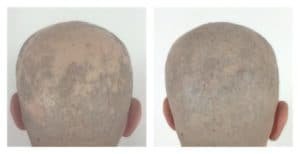 alopeacia-areata