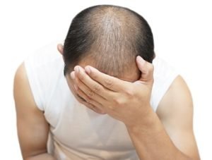 Técnicas de injerto capilar - caída del cabello