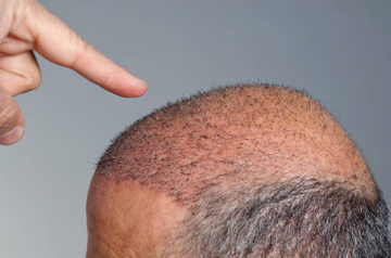 ¿Cuánto tarda en crecer el pelo después de un trasplante capilar?