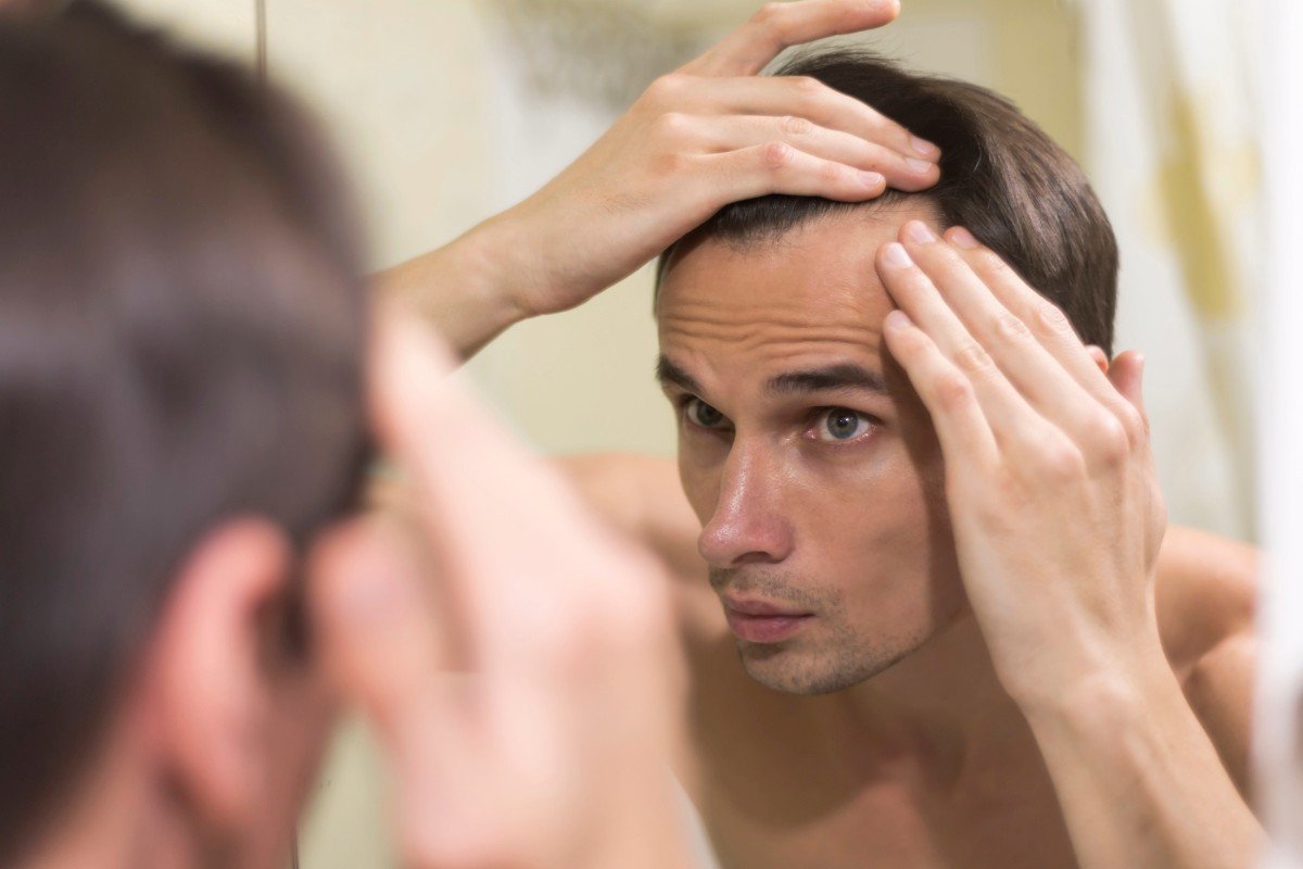 Alopecia frontal fibrosante: causas, síntomas y tratamientos